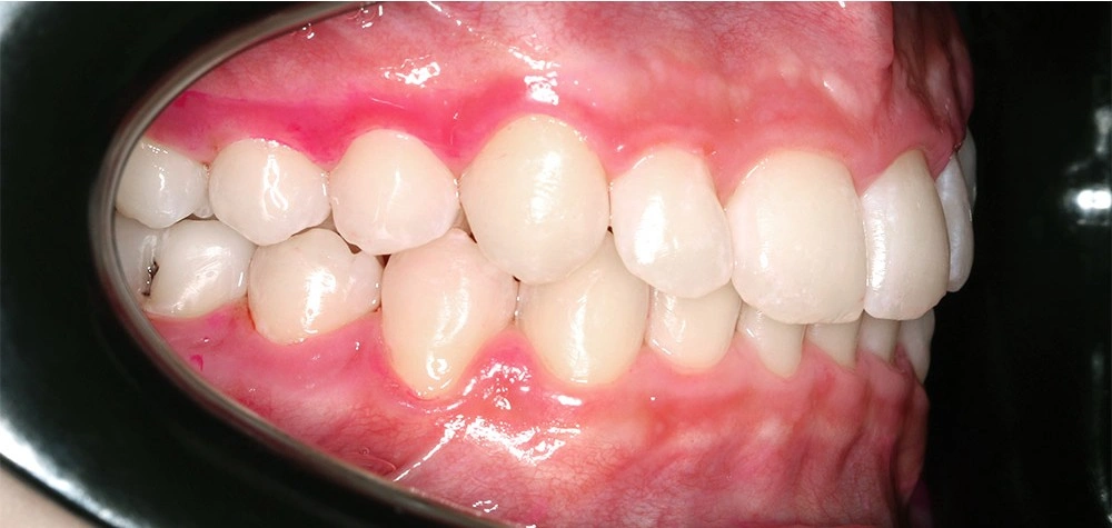 Глубокий прикус - Кейс 4 — боковой ракурс после лечения