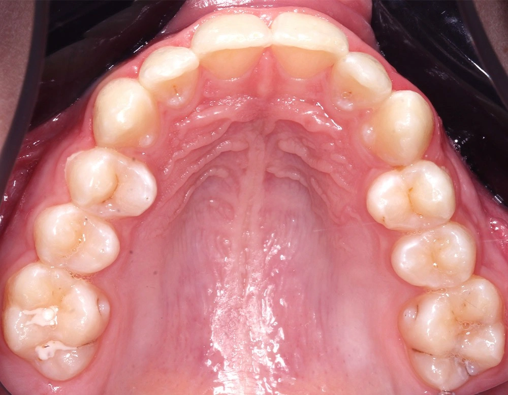 Глубокий прикус - Кейс 4 — верхняя челюсть до лечения