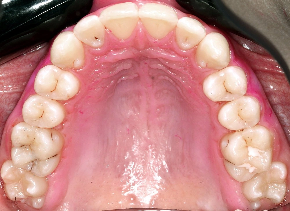 Глубокий прикус - Кейс 4 — верхняя челюсть после лечения