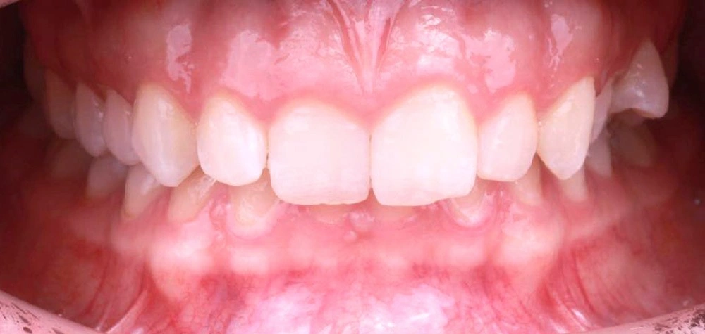 Глубокий прикус - Кейс 5 — фронтальный ракурс до лечения