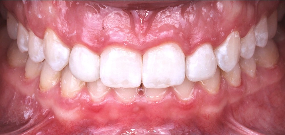 Глубокий прикус - Кейс 5 — фронтальный ракурс после лечения