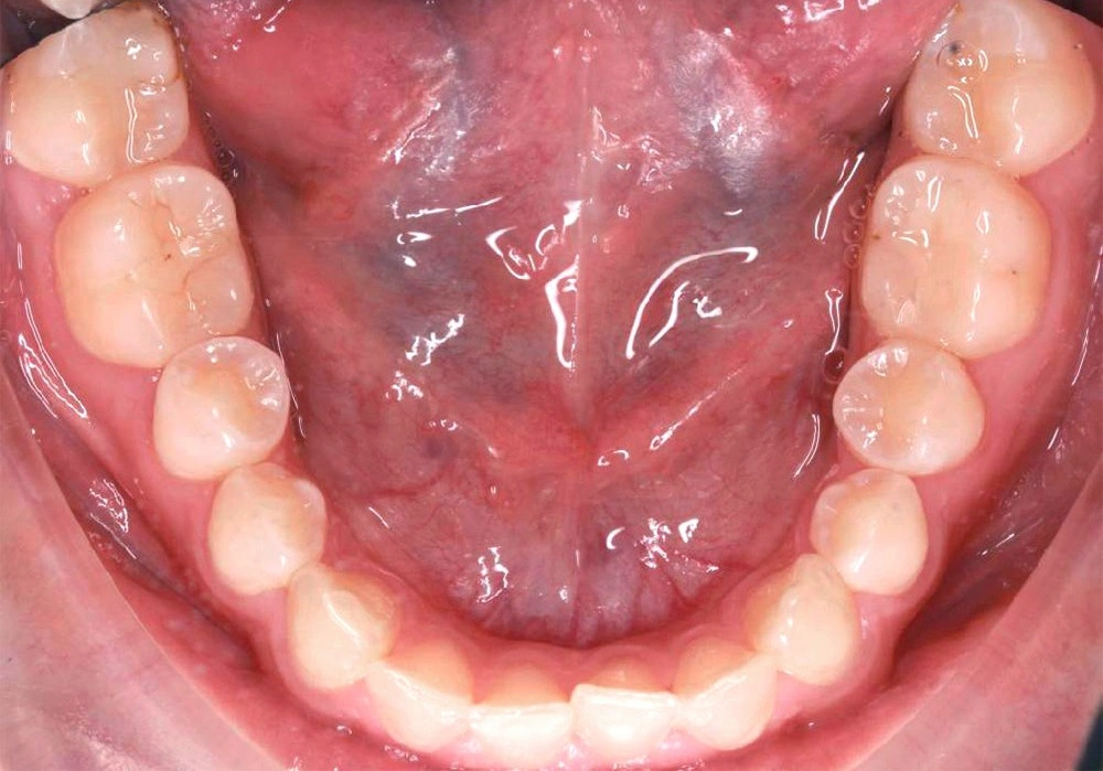 Глубокий прикус - Кейс 5 — нижняя челюсть до лечения