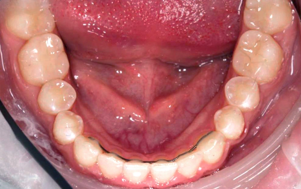 Глубокий прикус - Кейс 5 — нижняя челюсть после лечения