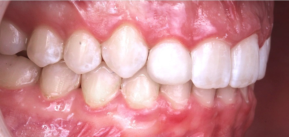 Глубокий прикус - Кейс 5 — боковой ракурс после лечения