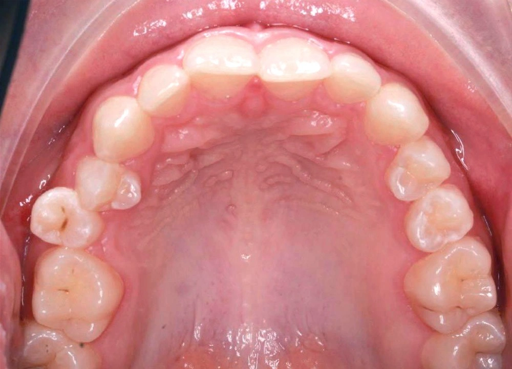 Глубокий прикус - Кейс 5 — верхняя челюсть до лечения