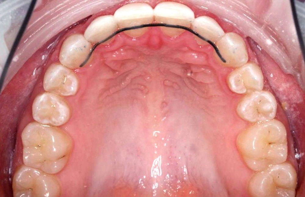 Глубокий прикус - Кейс 5 — верхняя челюсть после лечения