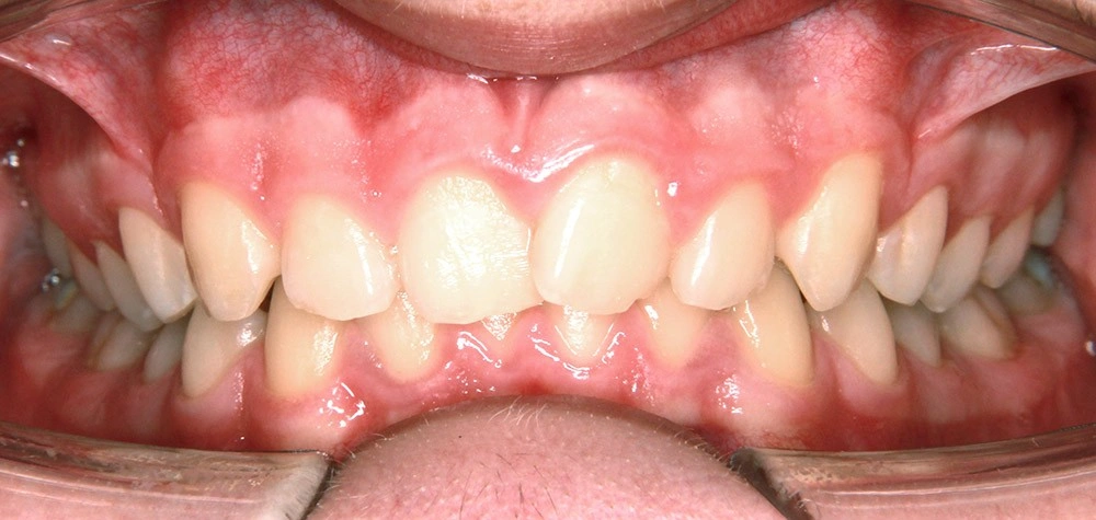 Глубокий прикус - Кейс 6 — фронтальный ракурс до лечения