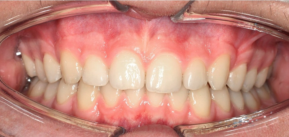 Глубокий прикус - Кейс 6 — фронтальный ракурс после лечения