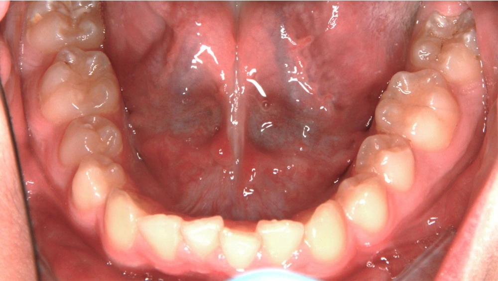 Глубокий прикус - Кейс 6 — нижняя челюсть до лечения