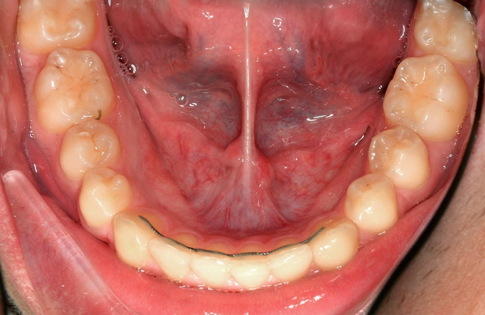 Глубокий прикус - Кейс 6 — нижняя челюсть после лечения