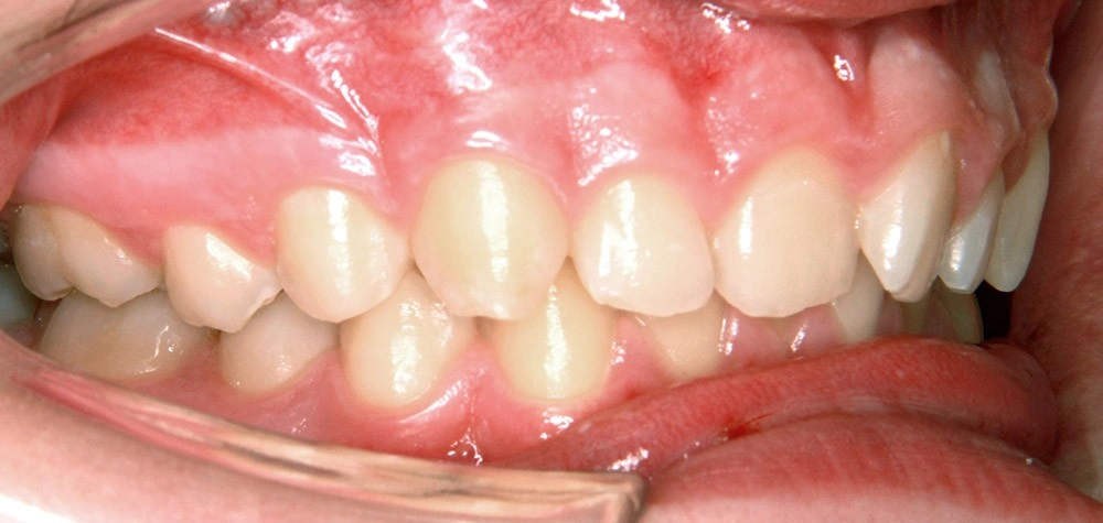 Глубокий прикус - Кейс 6 — боковой ракурс до лечения