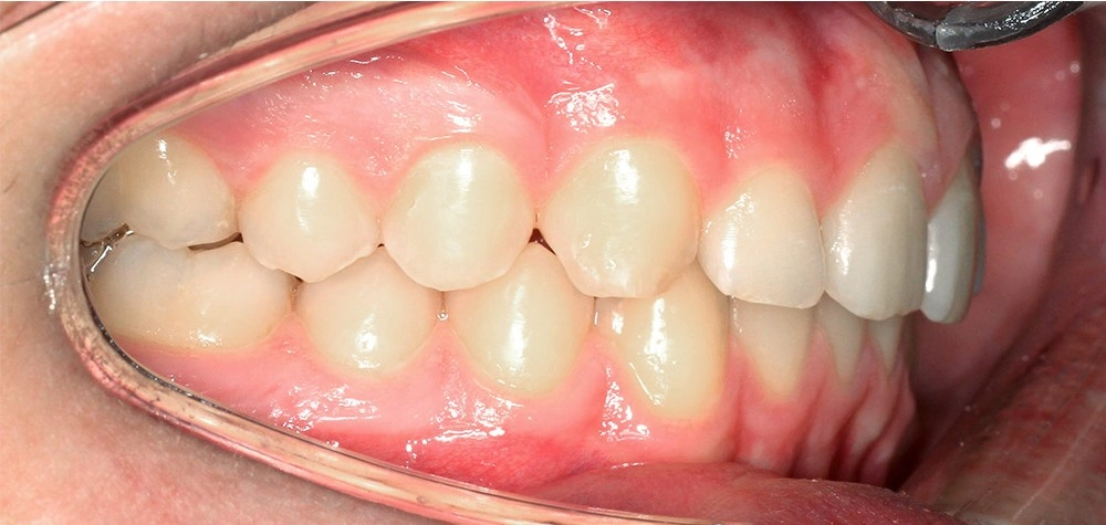 Глубокий прикус - Кейс 6 — боковой ракурс после лечения