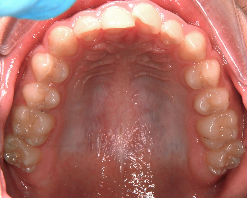 Глубокий прикус - Кейс 6 — верхняя челюсть до лечения