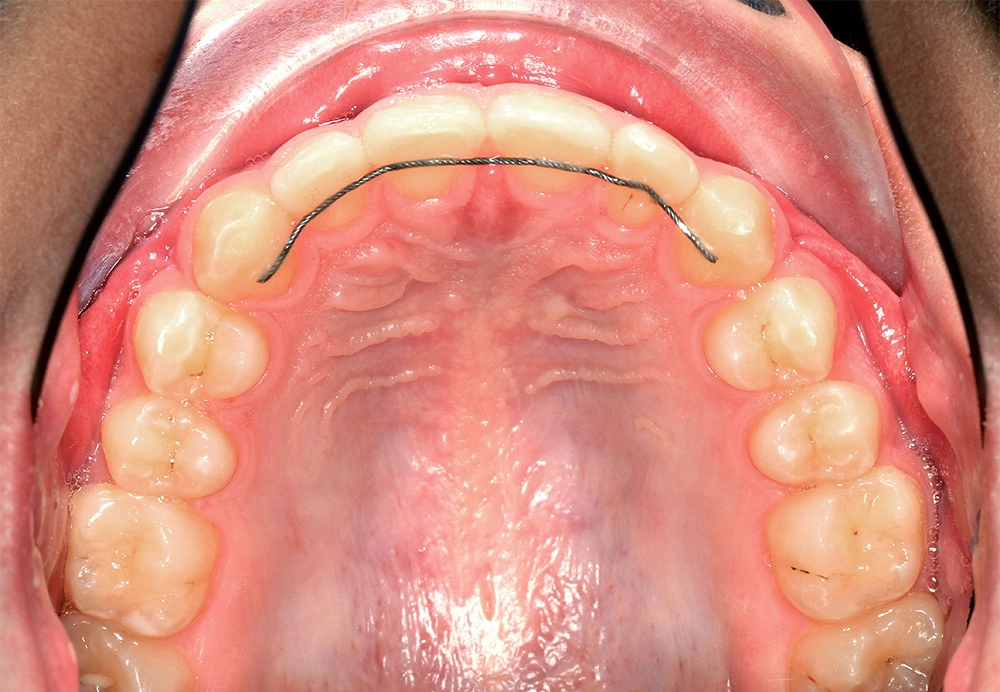 Глубокий прикус - Кейс 6 — верхняя челюсть после лечения