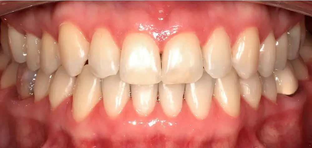 Мезиальный прикус - Кейс 1 — вид спереди после лечения