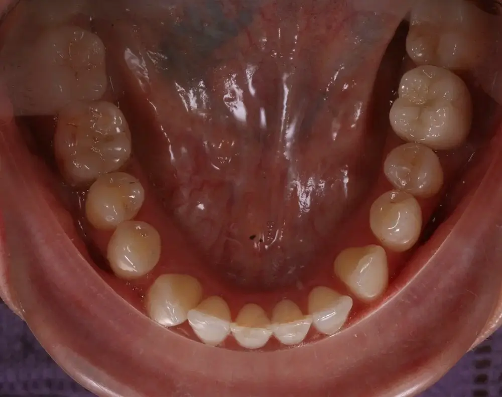 Мезиальный прикус - Кейс 1 — нижняя челюсть до лечения