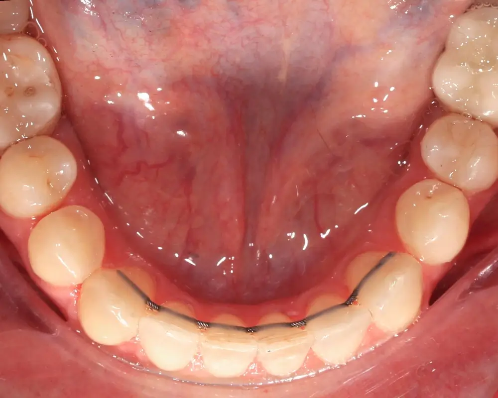 Мезиальный прикус - Кейс 1 — нижняя челюсть после лечения