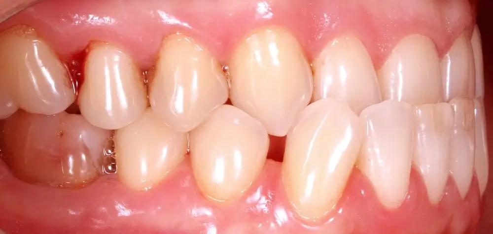 Мезиальный прикус - Кейс 1 — боковой ракурс до лечения