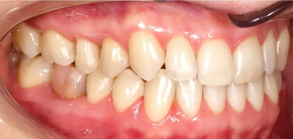 Мезиальный прикус - Кейс 1 — боковой ракурс после лечения