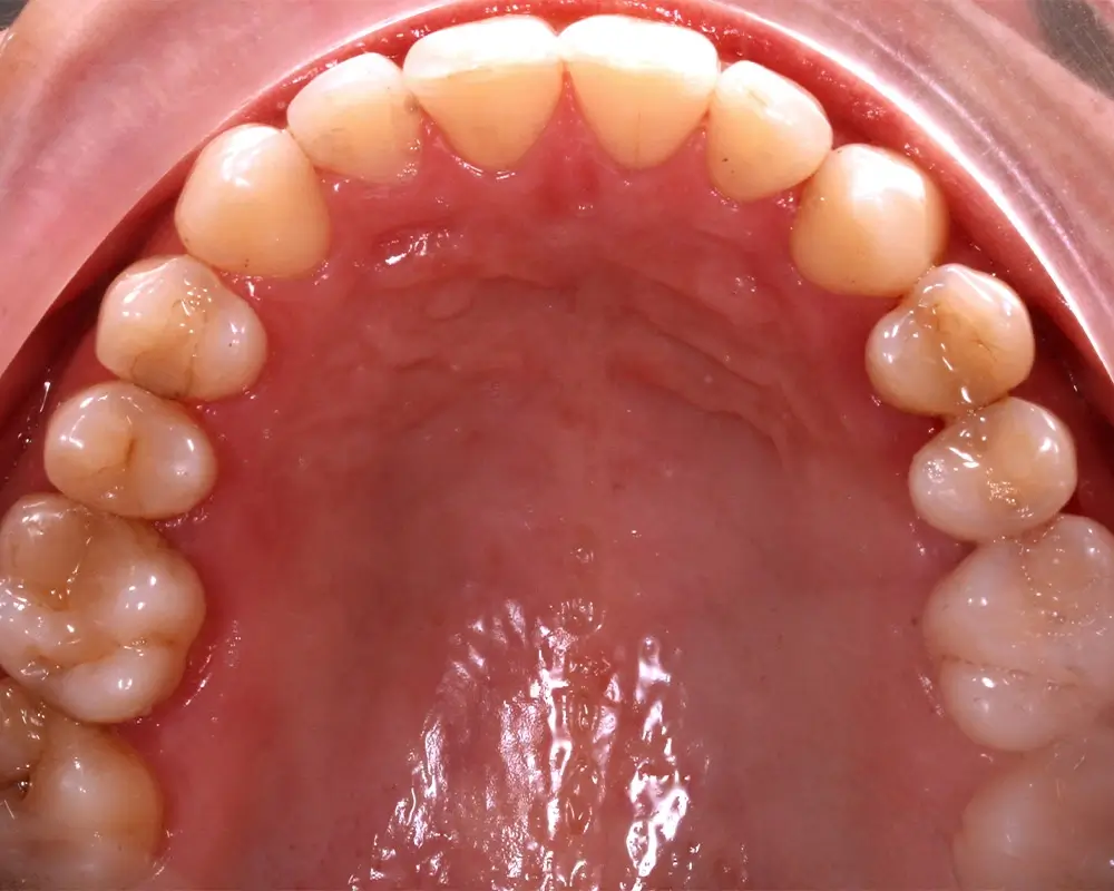 Мезиальный прикус - Кейс 1 — верхняя челюсть до лечения