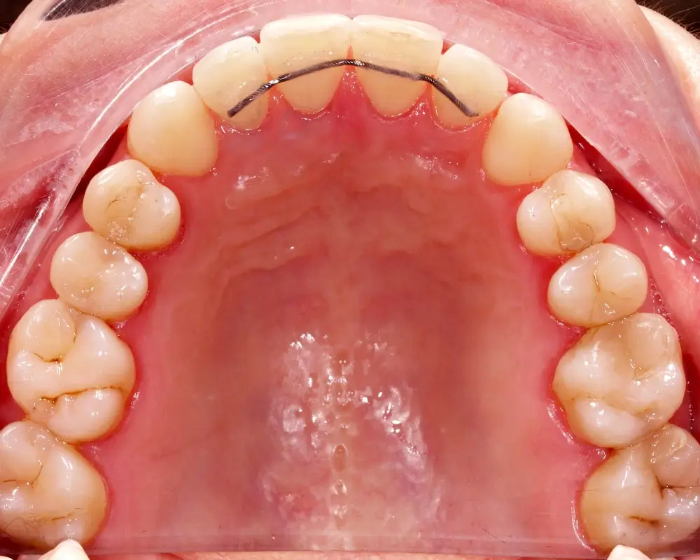 Мезиальный прикус - Кейс 1 — верхняя челюсть после лечения