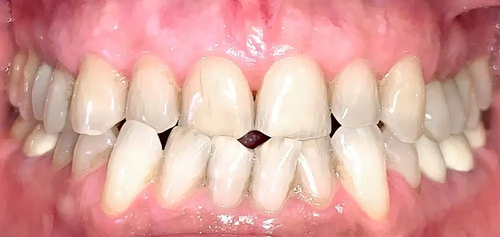 Мезиальный прикус - Кейс 2 — вид спереди до лечения