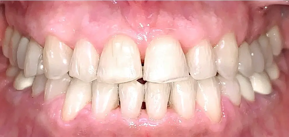 Мезиальный прикус - Кейс 2 — вид спереди после лечения