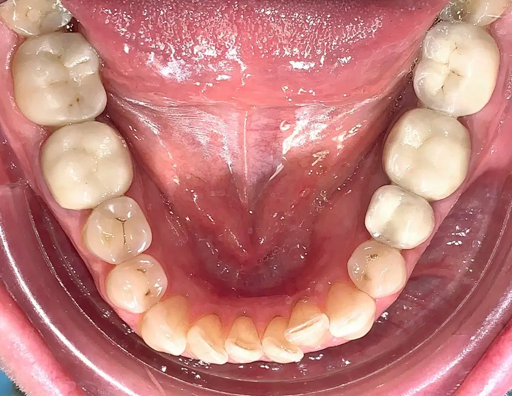 Мезиальный прикус - Кейс 2 — нижняя челюсть до лечения