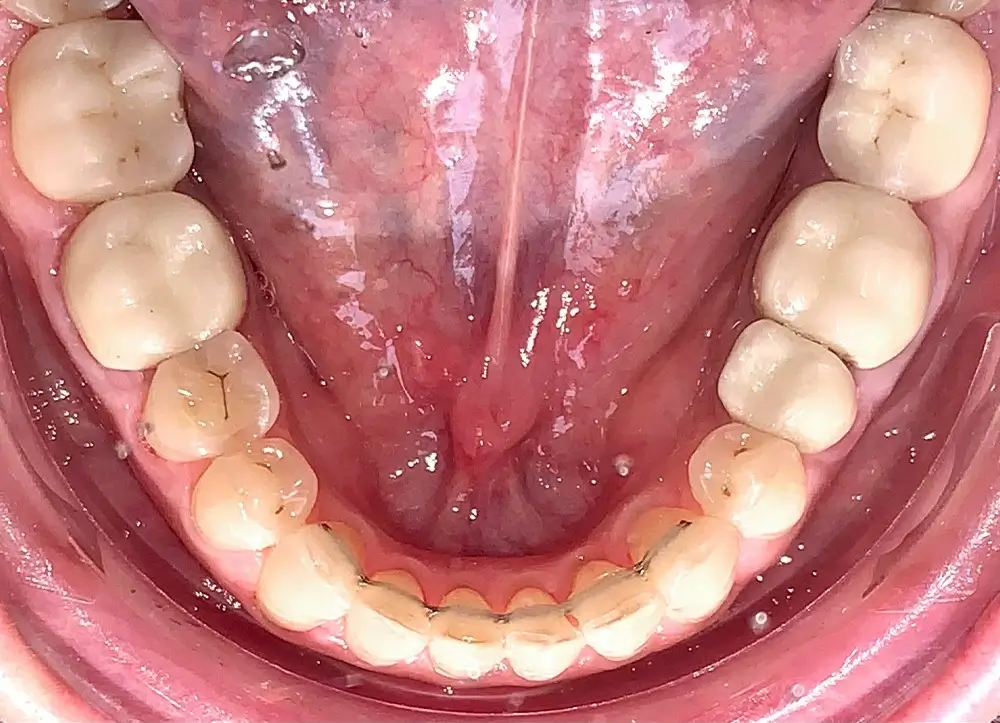 Мезиальный прикус - Кейс 2 — нижняя челюсть после лечения
