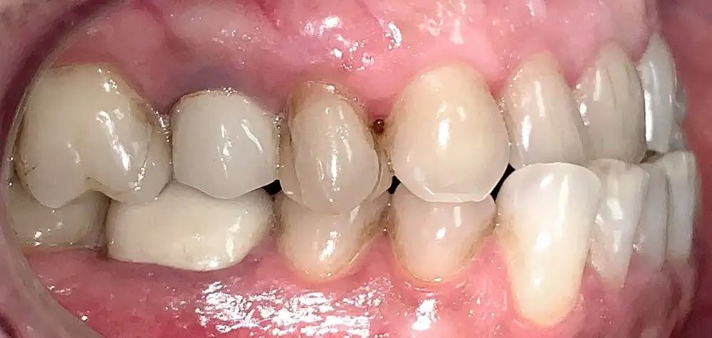 Мезиальный прикус - Кейс 2 — боковой  ракурс до лечения