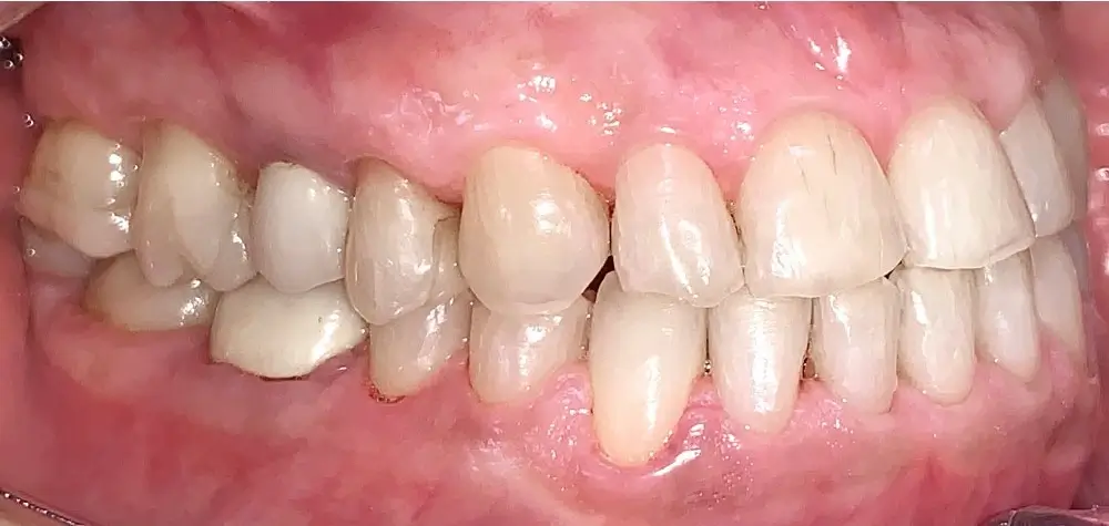 Мезиальный прикус - Кейс 2 — боковой ракурс после лечения