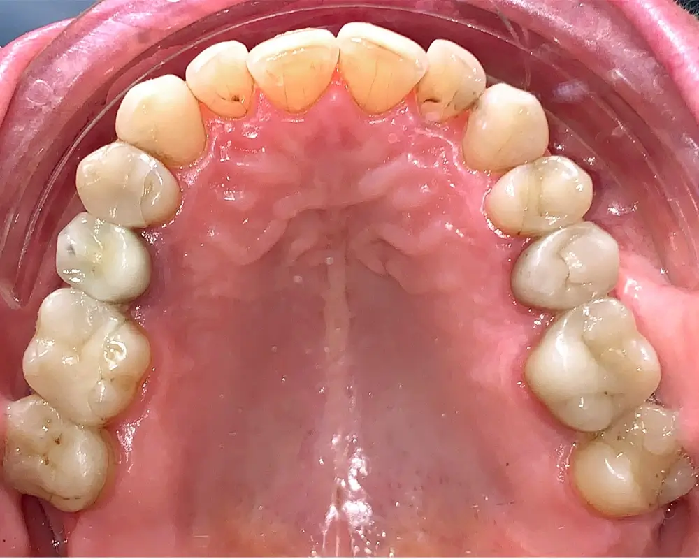 Мезиальный прикус - Кейс 2 — верхняя челюсть до лечения