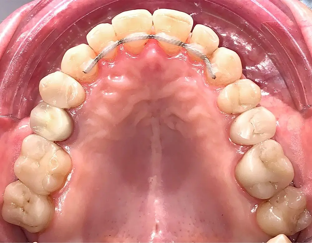 Мезиальный прикус - Кейс 2 — верхняя челюсть после лечения