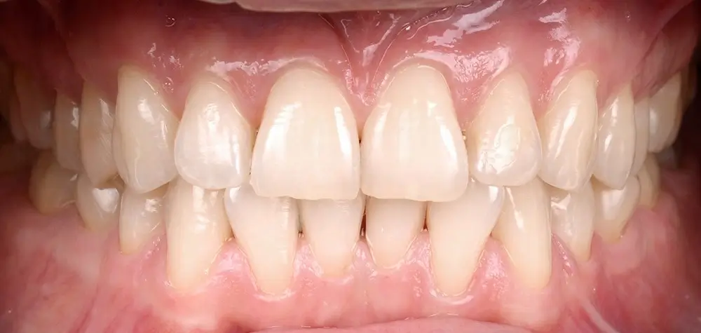 Мезиальный прикус - Кейс 3 — вид спереди до лечения