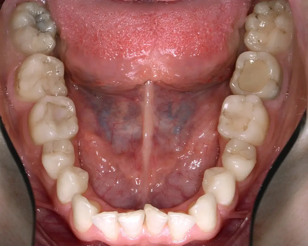 Мезиальный прикус - Кейс 3 — нижняя челюсть до лечения