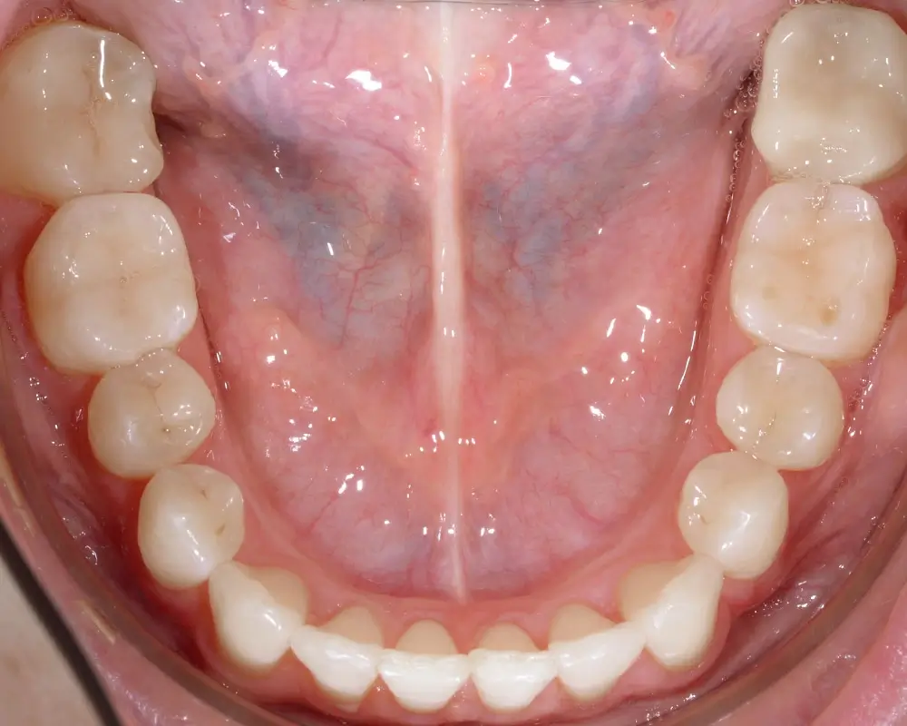 Мезиальный прикус - Кейс 3 — нижняя челюсть после лечения