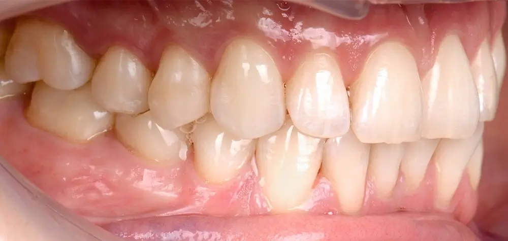 Мезиальный прикус - Кейс 3 — боковой ракурс до лечения