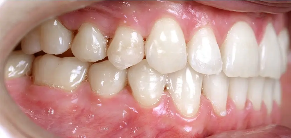 Мезиальный прикус - Кейс 3 — боковой ракурс после лечения