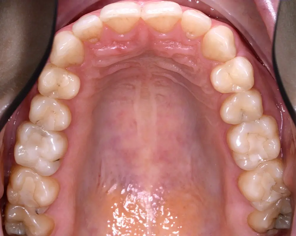 Мезиальный прикус - Кейс 3 — верхняя челюсть до лечения