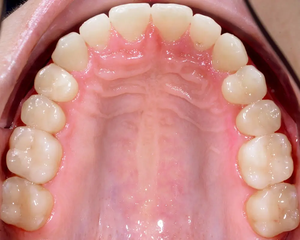 Мезиальный прикус - Кейс 3 — верхняя челюсть после лечения