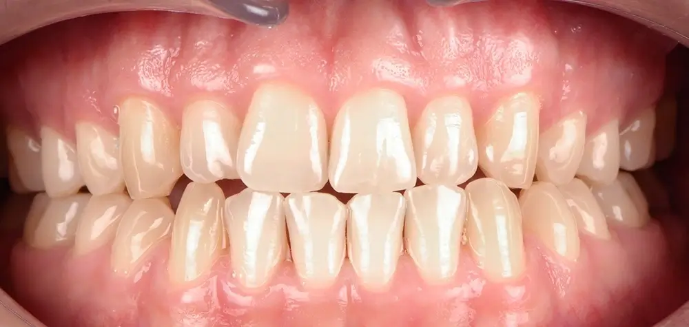 Мезиальный прикус - Кейс 4 — вид спереди до лечения