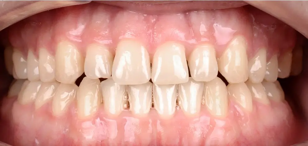 Мезиальный прикус - Кейс 4 — вид спереди после лечения