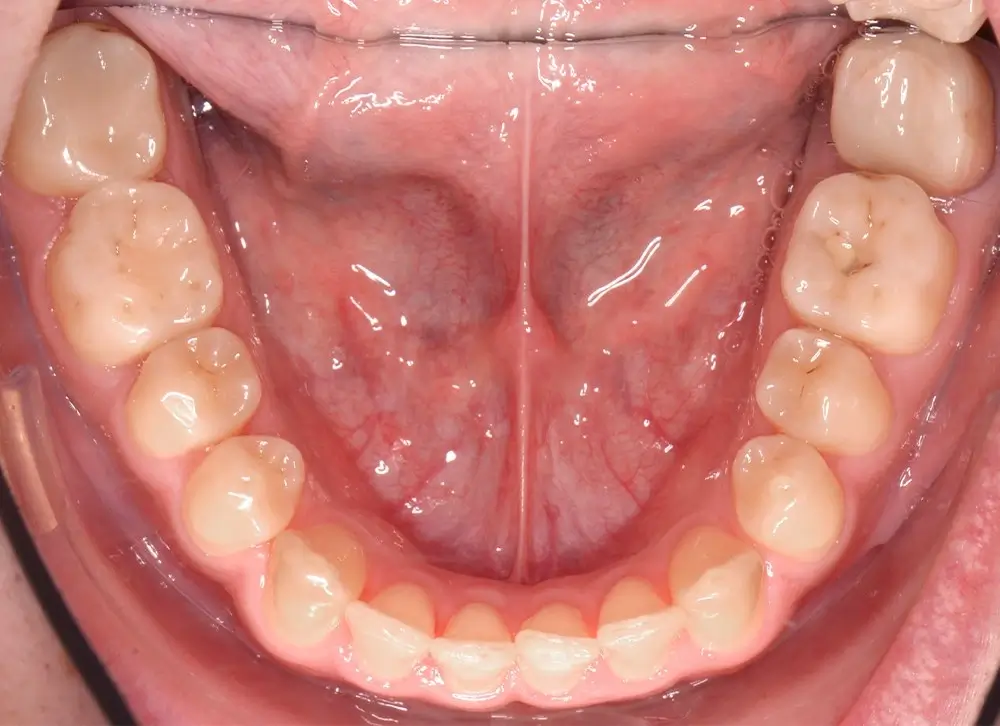 Мезиальный прикус - Кейс 4 — нижняя челюсть до лечения