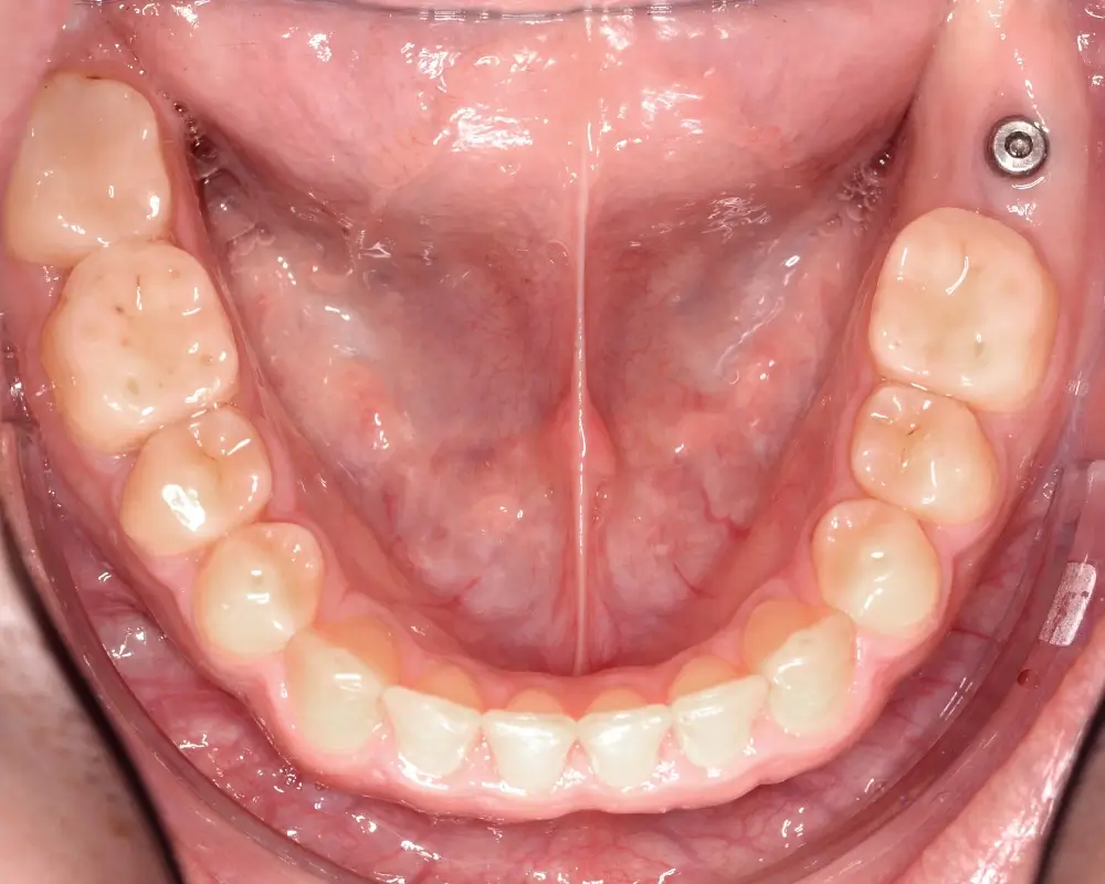 Мезиальный прикус - Кейс 4 — нижняя челюсть после лечения