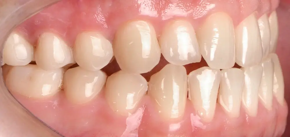 Мезиальный прикус - Кейс 4 — боковой ракурс до лечения