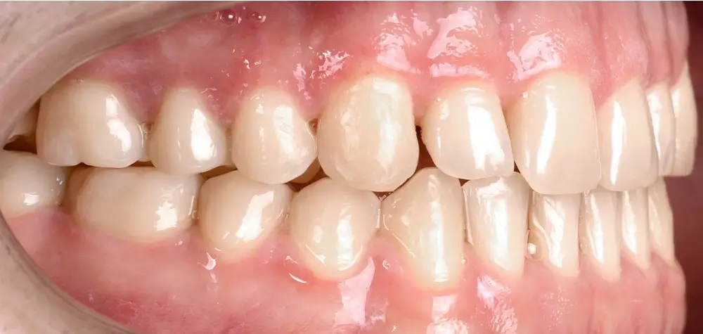 Мезиальный прикус - Кейс 4 — боковой ракурс после лечения