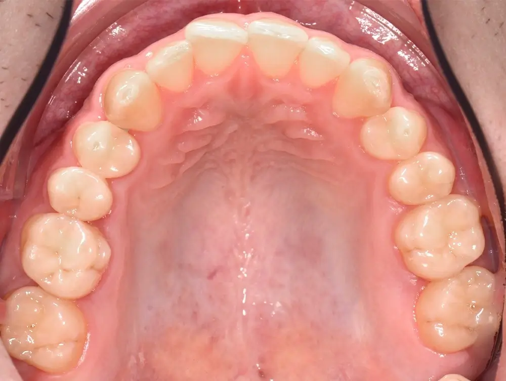 Мезиальный прикус - Кейс 4 — верхняя челюсть до лечения