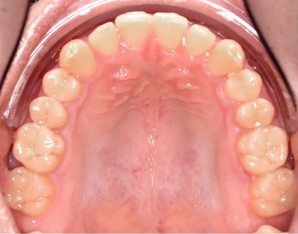 Мезиальный прикус - Кейс 4 — верхняя челюсть после лечения