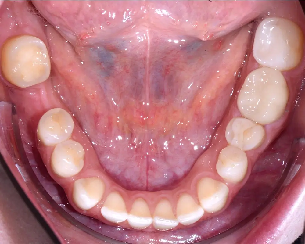 Мезиальный прикус - Кейс 5 — нижняя челюсть до лечения