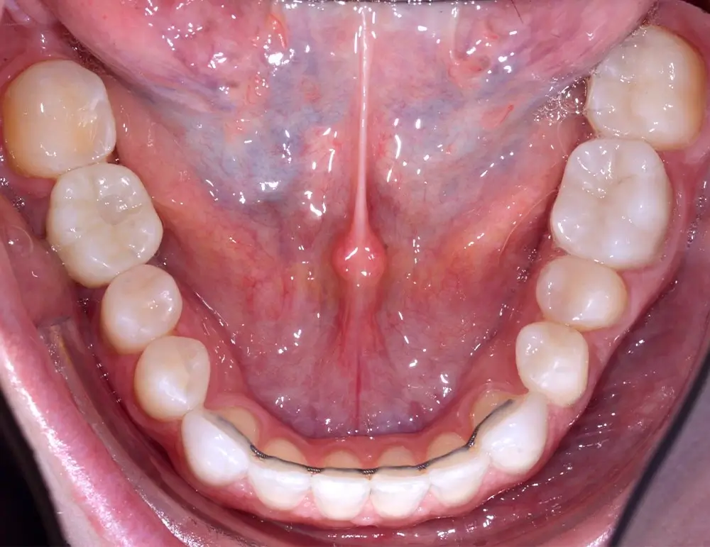 Мезиальный прикус - Кейс 5 — нижняя челюсть после лечения